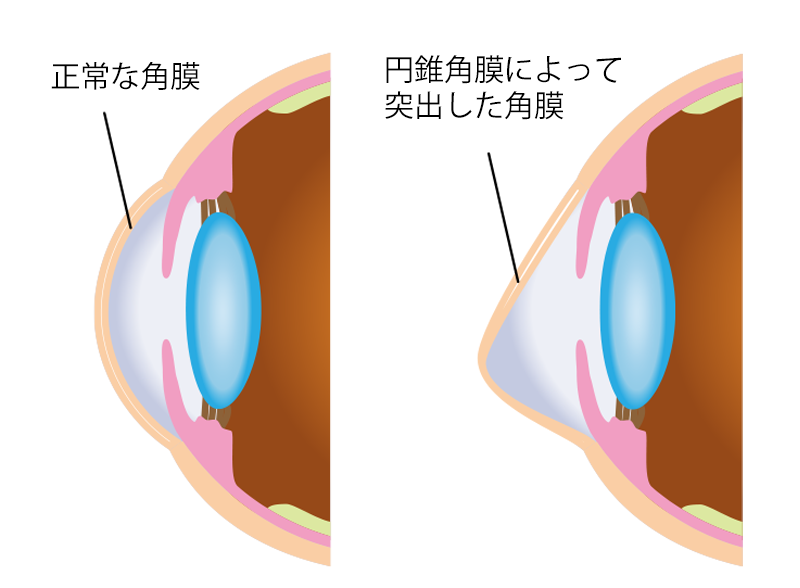 円錐角膜